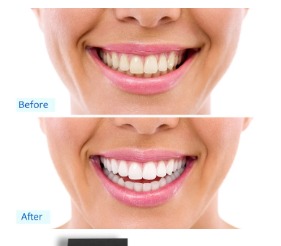 Miniatura 3 de Dental White Mini Luz Blanqueadora para